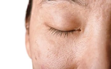 Manchas y deshidratación: recupera tu piel después del verano