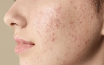 Efecto rebote del acné después del verano: por qué ocurre y cómo evitarlo