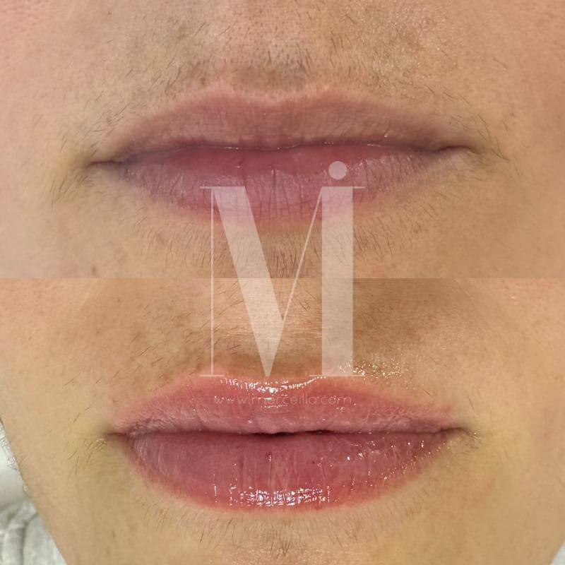 Facialista Resultado Tratamiento de labios en Barcelona y en Palautordera