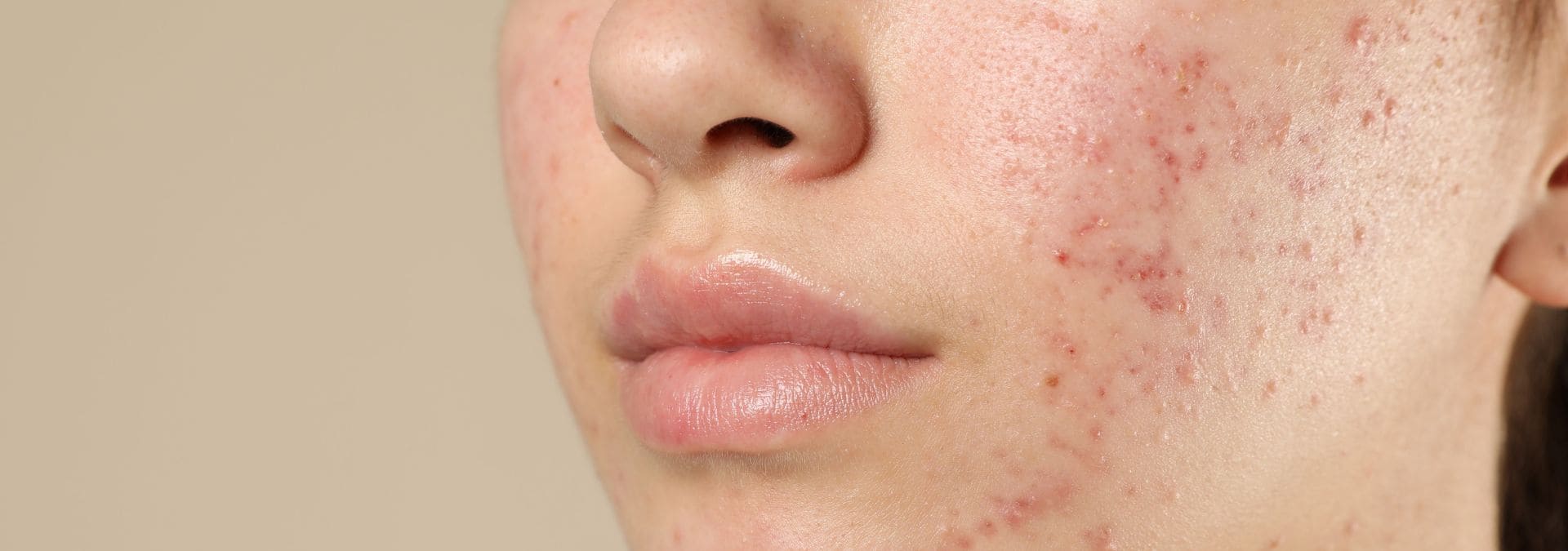 Tratamiento piel con acne barcelonaslider_item_cP4KXz