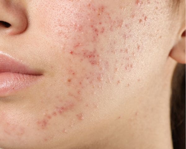 Tratamiento piel con acne barcelona