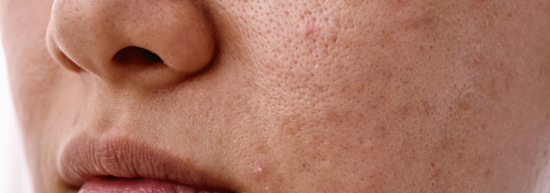 tratamiento facial piel grasa barcelonaslider_item_cP4KXz