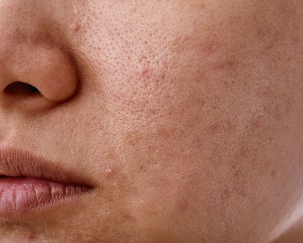 Tratamiento facial piel grasa barcelona