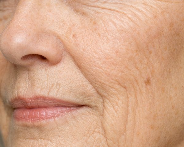 Tratamiento facial arrugas y flacidez barcelona