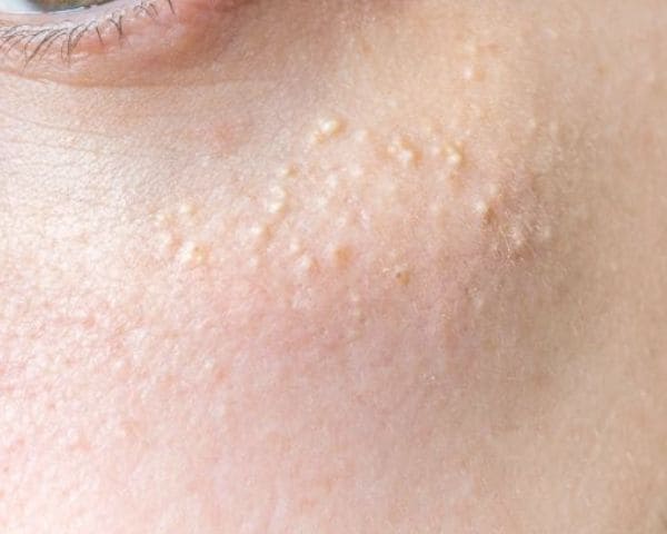 Tratamiento facial para eliminar miliums Barcelona