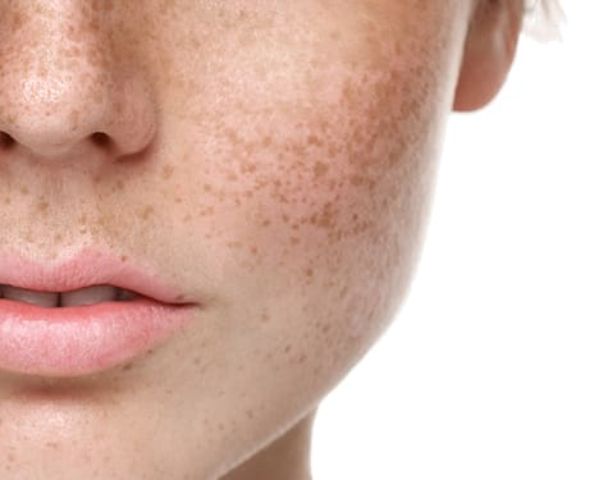 Tratamiento facial piel seca barcelona