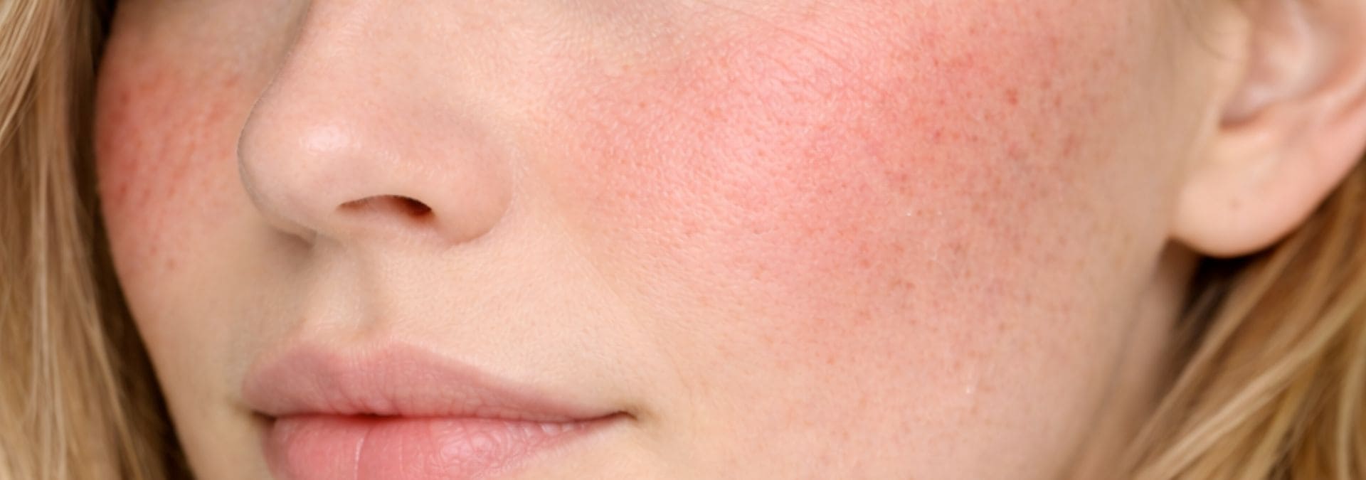 Tratamiento Facial para piel sensible barcelonaslider_item_cP4KXz